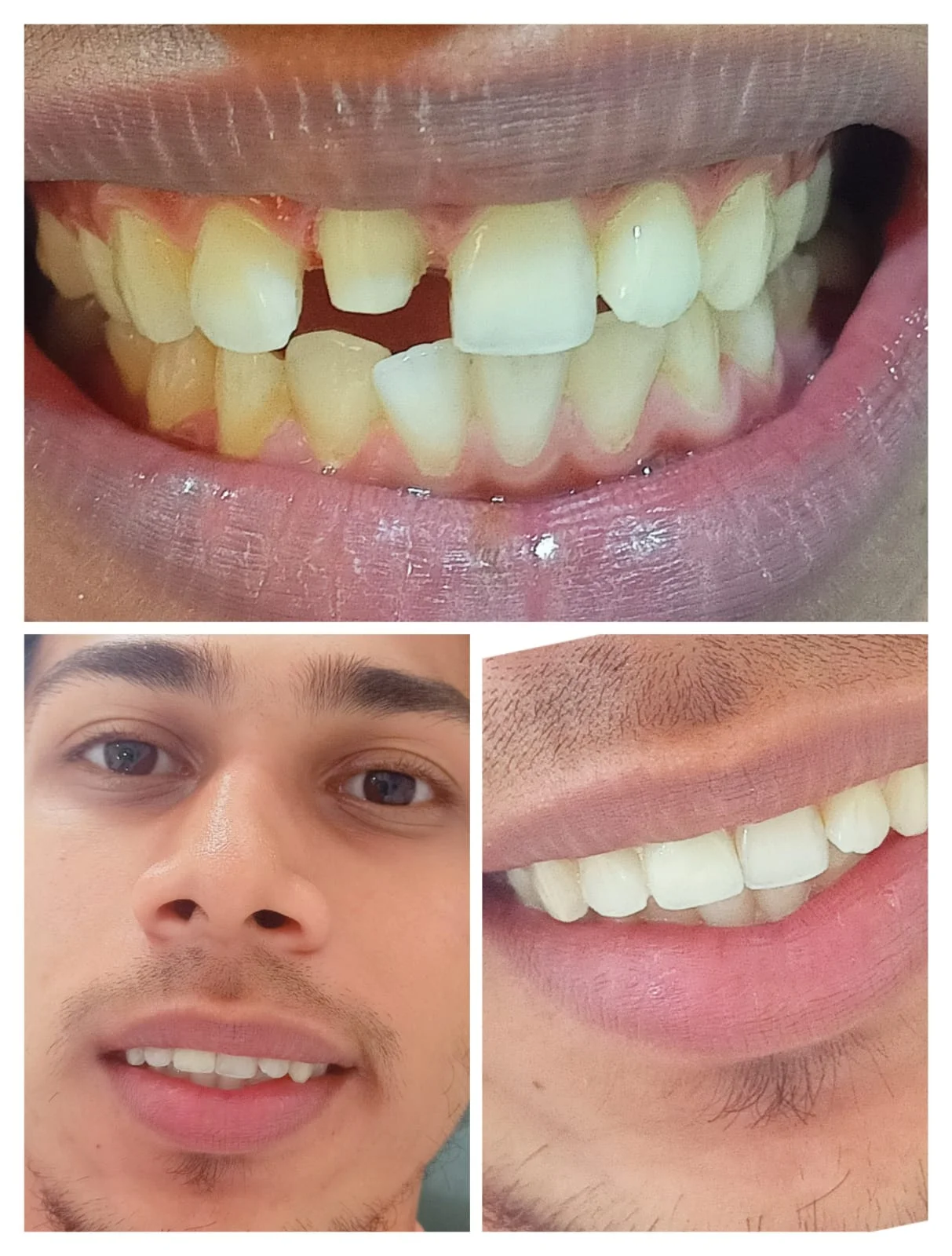 Anterior Smile Correction #2